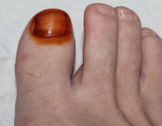 Iodine fungus treatment