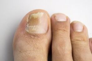 The disease with a fungus