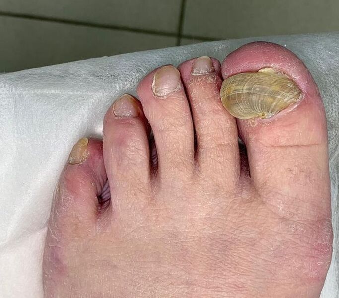 Hypertrophic onychomycosis in the leg - deformed nail