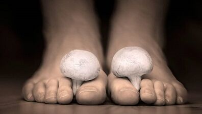 How to recognize the presence of fungus in the legs