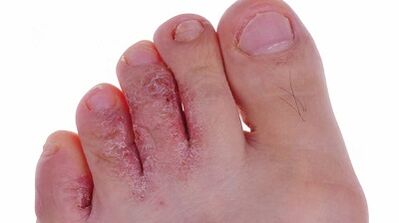 Types and stages of the development of fungi in the legs