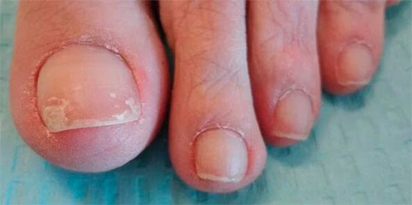 fungal leg stages