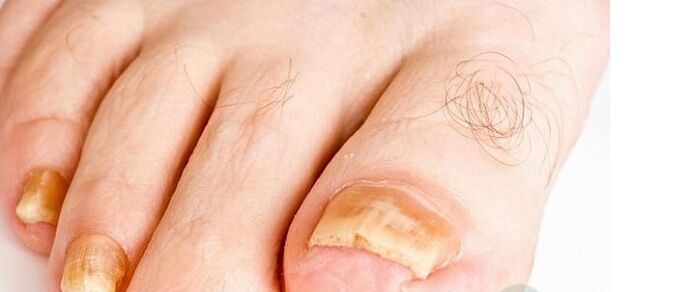 Fungal fungus varieties of the fingertips