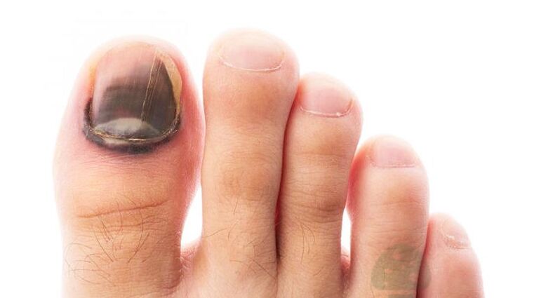 The disease stage of the disease with a thumb nail fungus