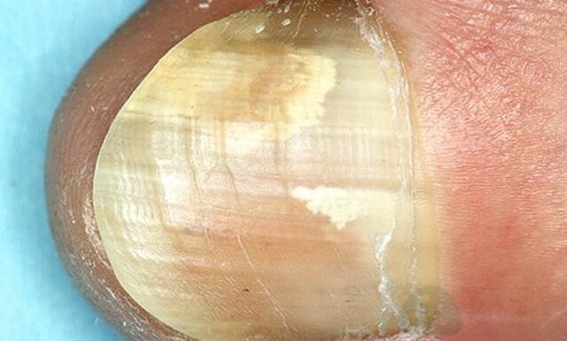Treatment of fingertips with internal action medicines