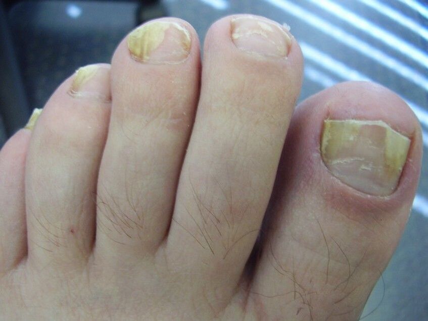 nail fungus symptoms