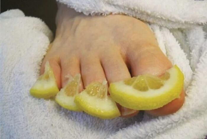 Lemon drop compresses - a popular remedy for nail fungus