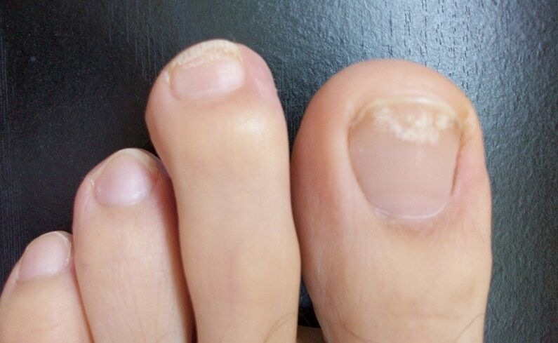 The initial signs of the fungus are a change in the color of the nail plate, the appearance of spots